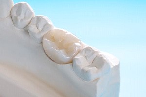 Dental crown on plaster dental model