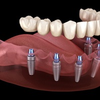 Illustration of implant denture for lower dental arch