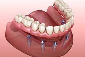 Implant dentures for lower arch, supported by six implants