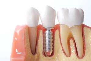 Model showing dental implants in Watertown