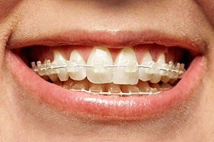 Closeup of dental patient with Six Month Smiles braces