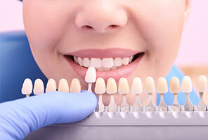 Smile compared with tooth colored filling shade options