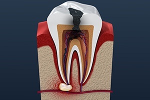 Animated inside of a tooth in need of root canal therapy