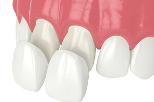 Illustration of veneers being placed on front teeth